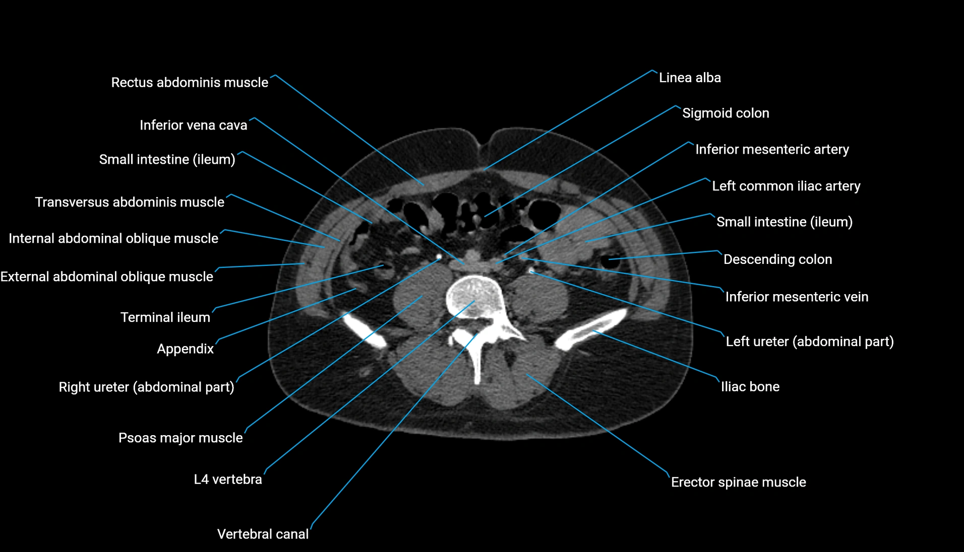 CT urogram axial cross sectional anatomy  labelled radiology image-00155.webp